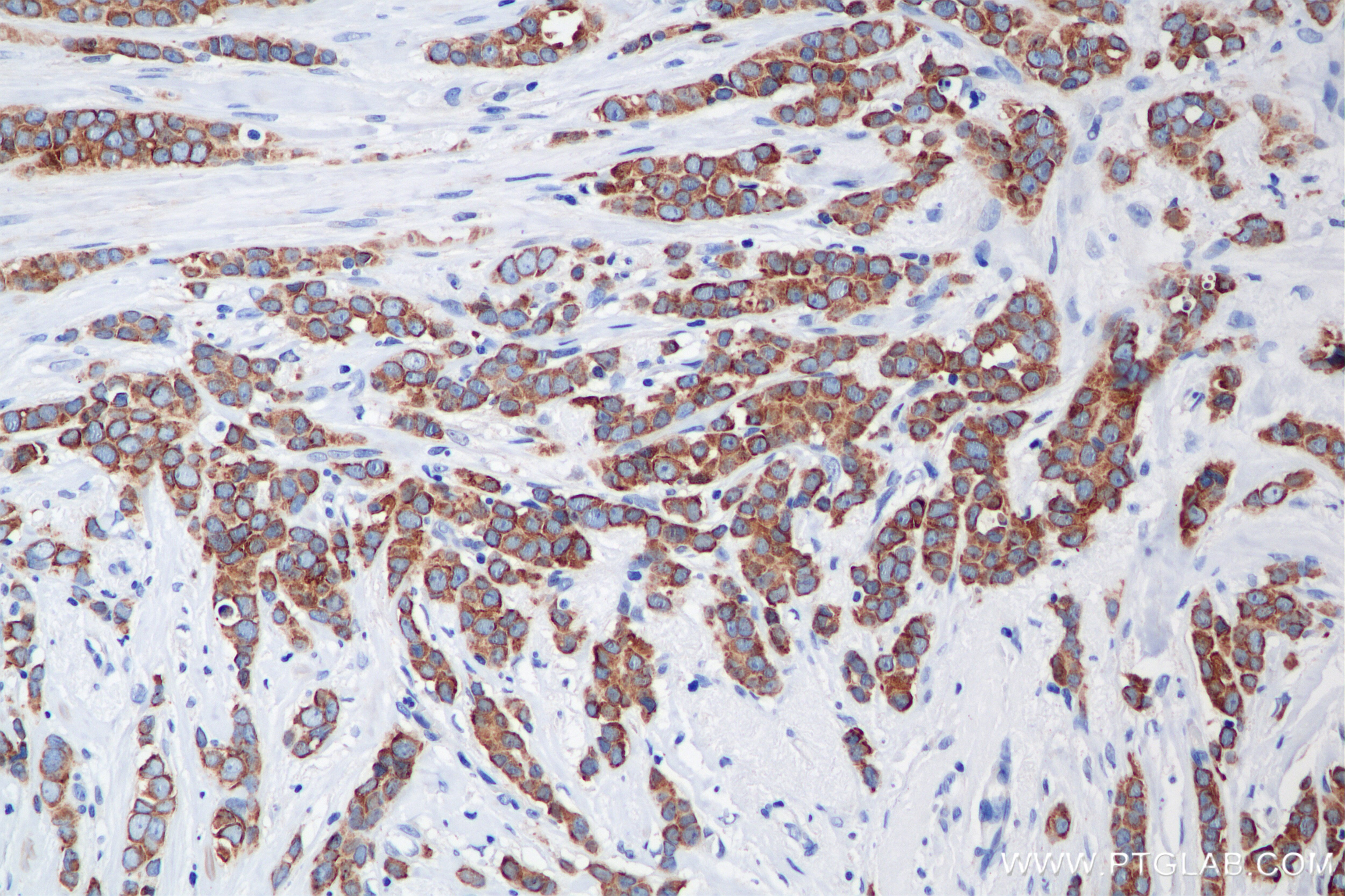 Immunohistochemistry (IHC) staining of human breast cancer tissue using Cytokeratin 19 Recombinant antibody (86250-1-RR)