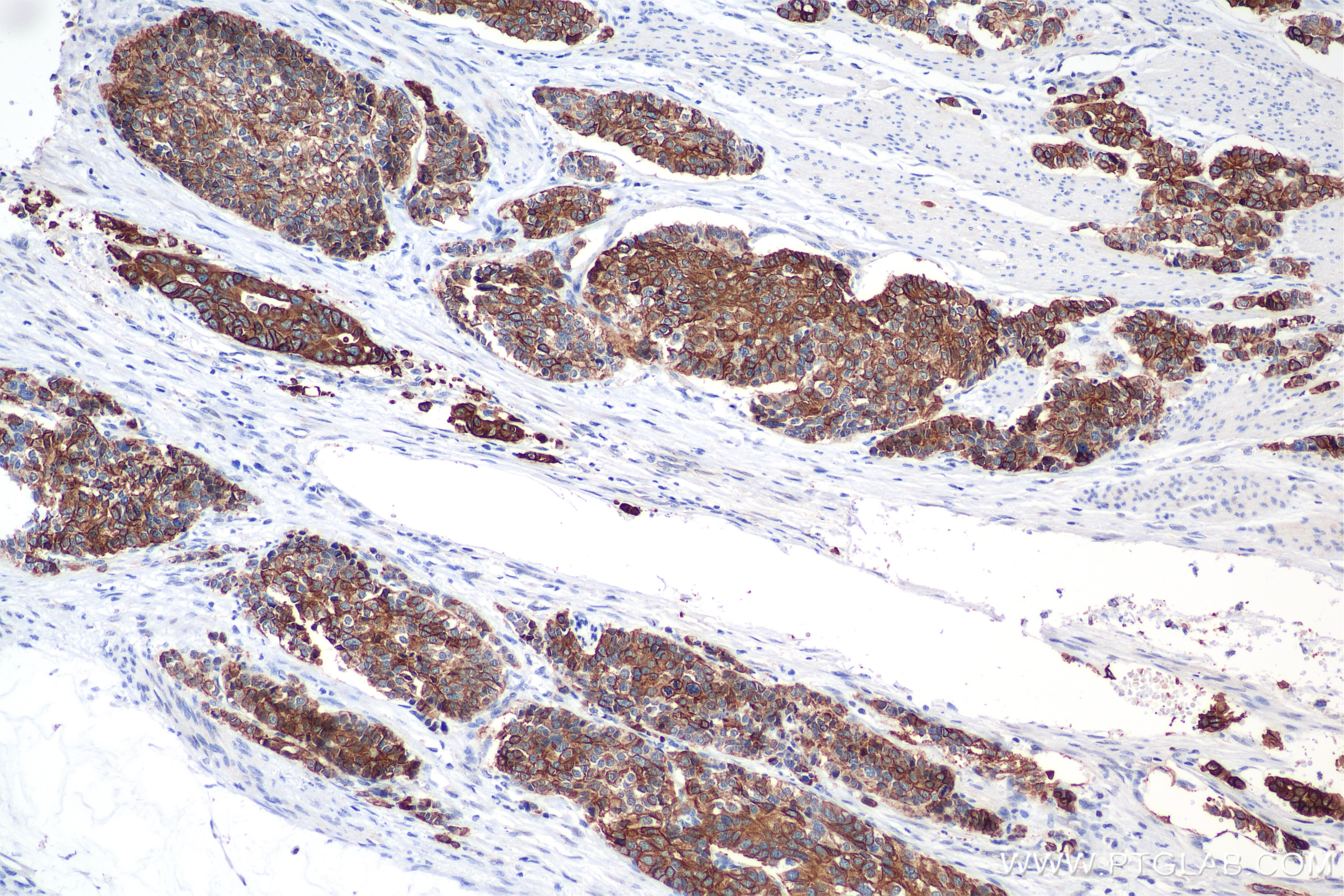 Immunohistochemistry (IHC) staining of human stomach cancer tissue using Cytokeratin 19 Recombinant antibody (86250-1-RR)