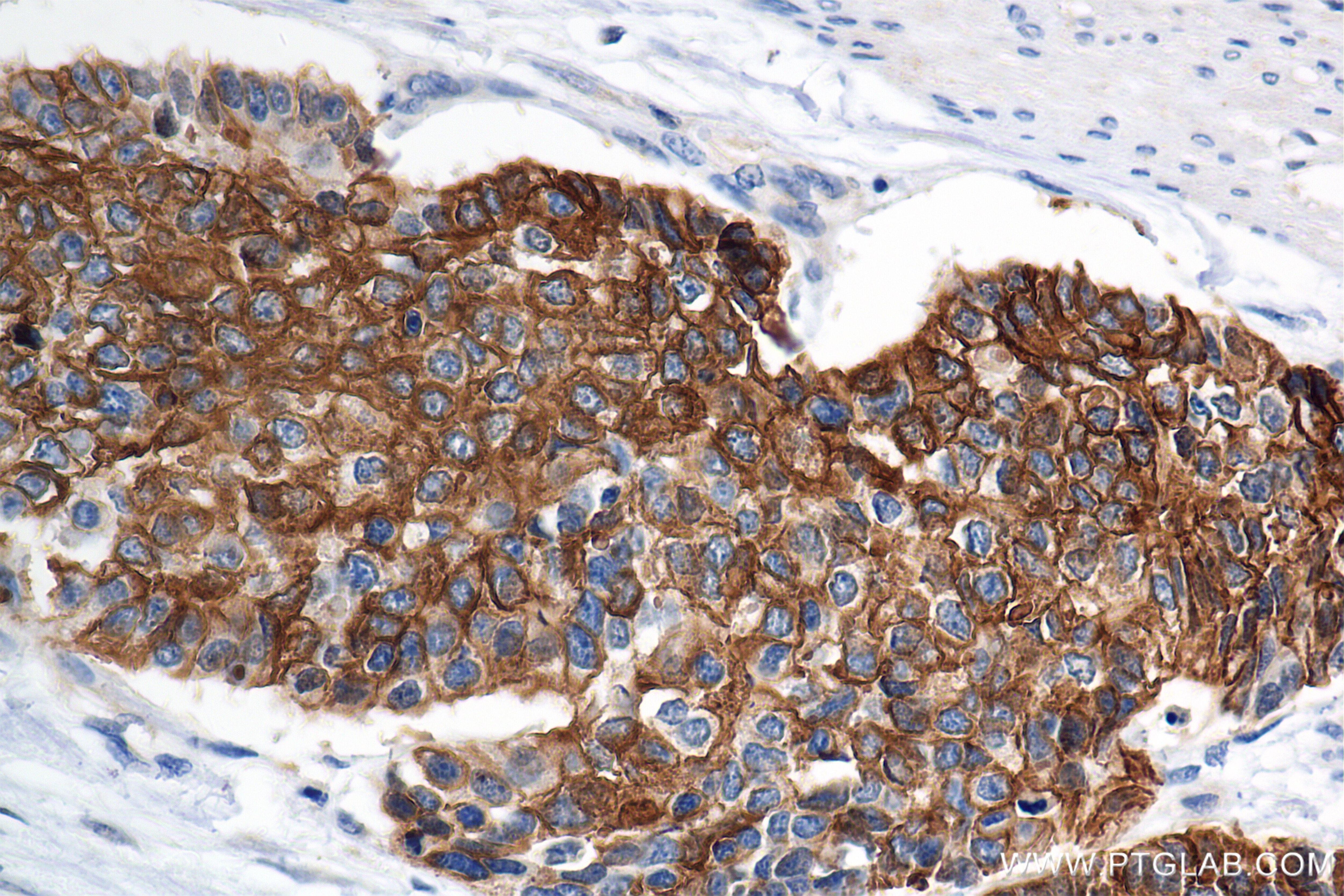 Immunohistochemistry (IHC) staining of human stomach cancer tissue using Cytokeratin 19 Recombinant antibody (86250-1-RR)