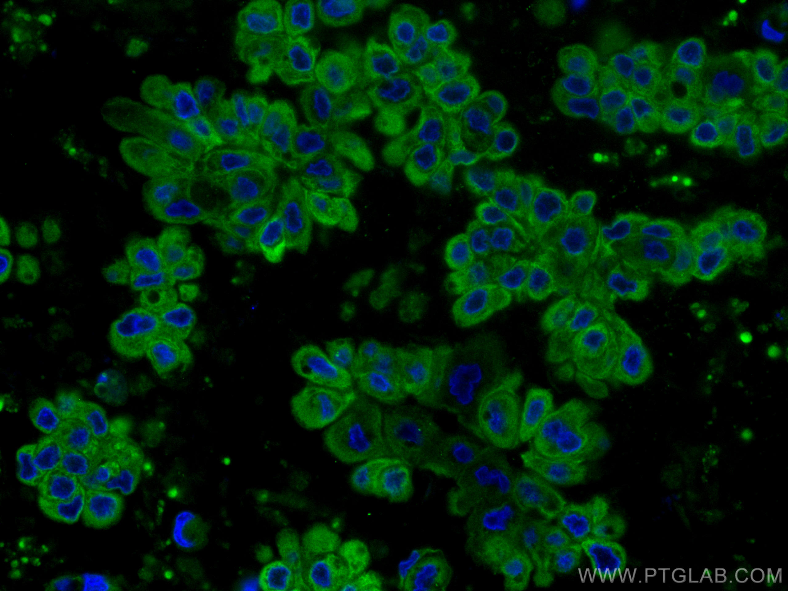 Immunofluorescence (IF) / fluorescent staining of human breast cancer tissue using CoraLite® Plus 488-conjugated Cytokeratin 19 Monoc (CL488-60187)