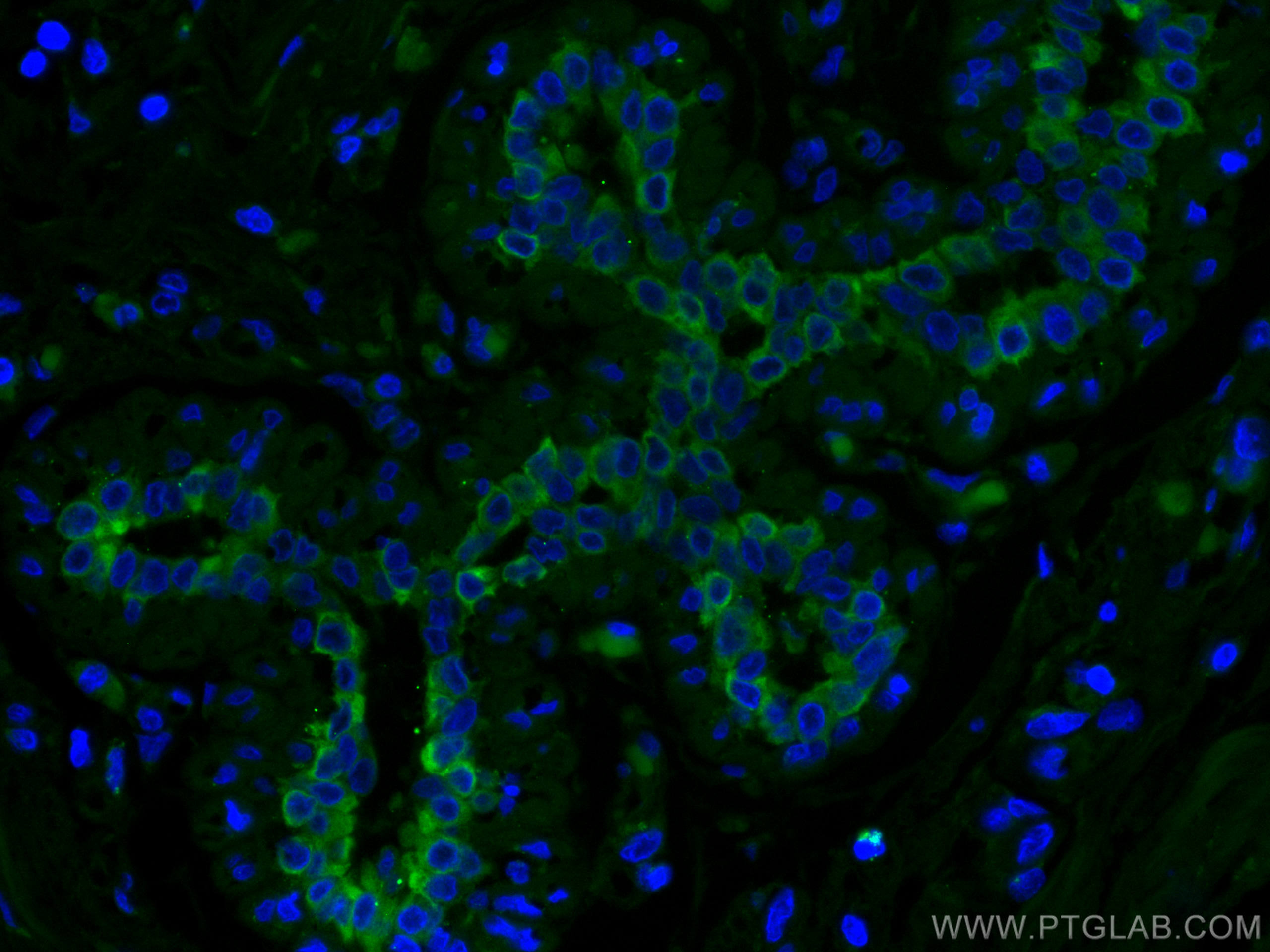 IF Staining of human breast cancer using CL488-60187