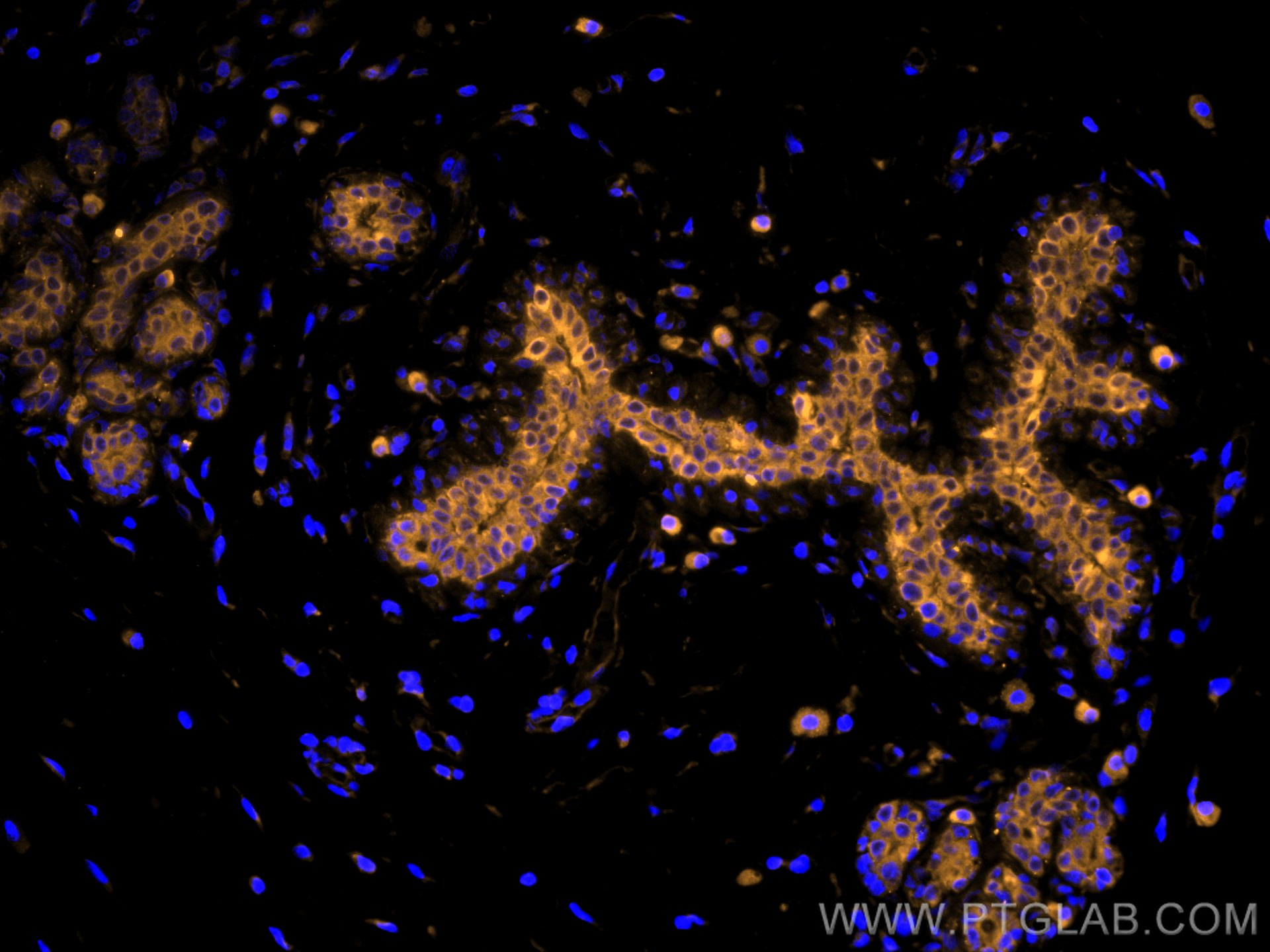 Immunofluorescence (IF) / fluorescent staining of human breast cancer tissue using CoraLite®555-conjugated Cytokeratin 19 Monoclonal  (CL555-60187)