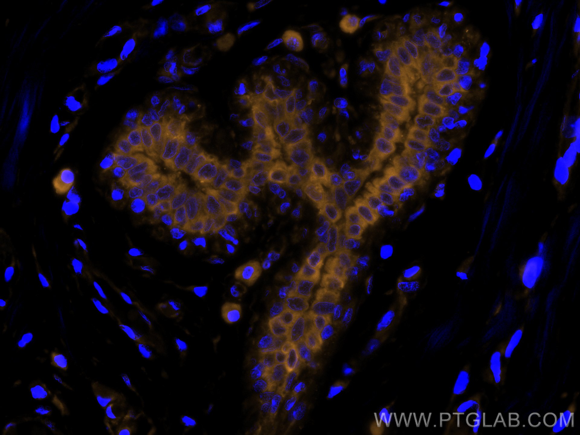 Immunofluorescence (IF) / fluorescent staining of human breast cancer tissue using CoraLite®555-conjugated Cytokeratin 19 Monoclonal  (CL555-60187)