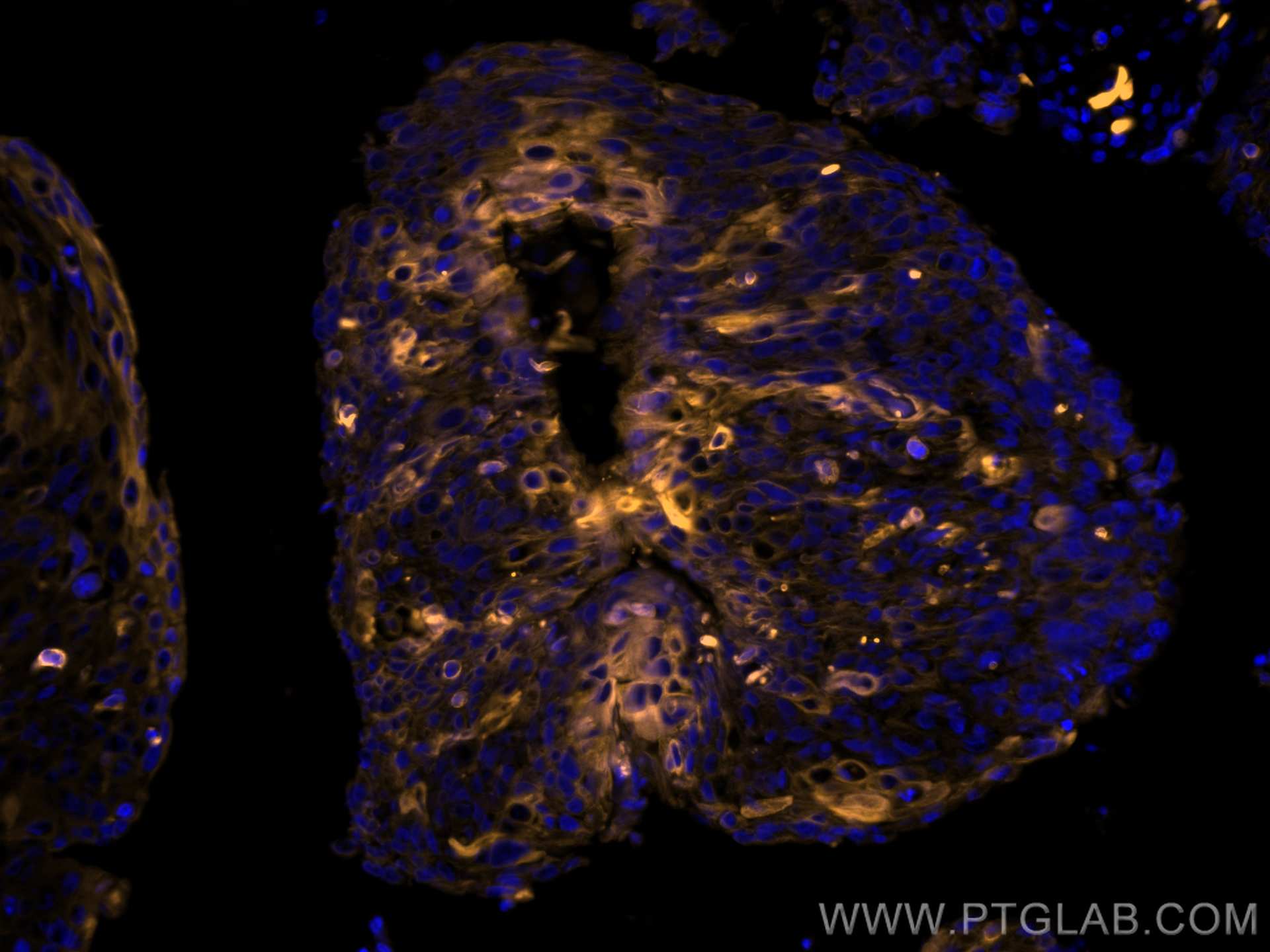 IF Staining of human oesophagus cancer using CL555-60187