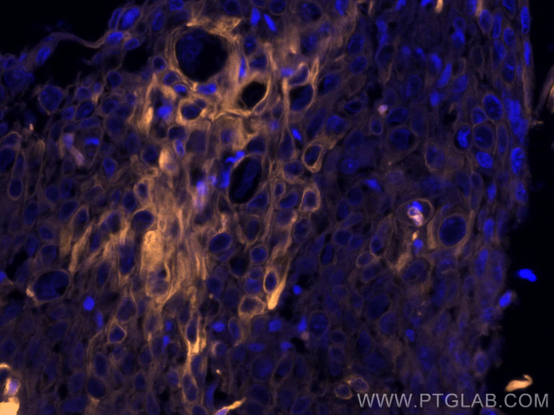 Immunofluorescence (IF) / fluorescent staining of human oesophagus cancer tissue using CoraLite®555-conjugated Cytokeratin 19 Monoclonal  (CL555-60187)