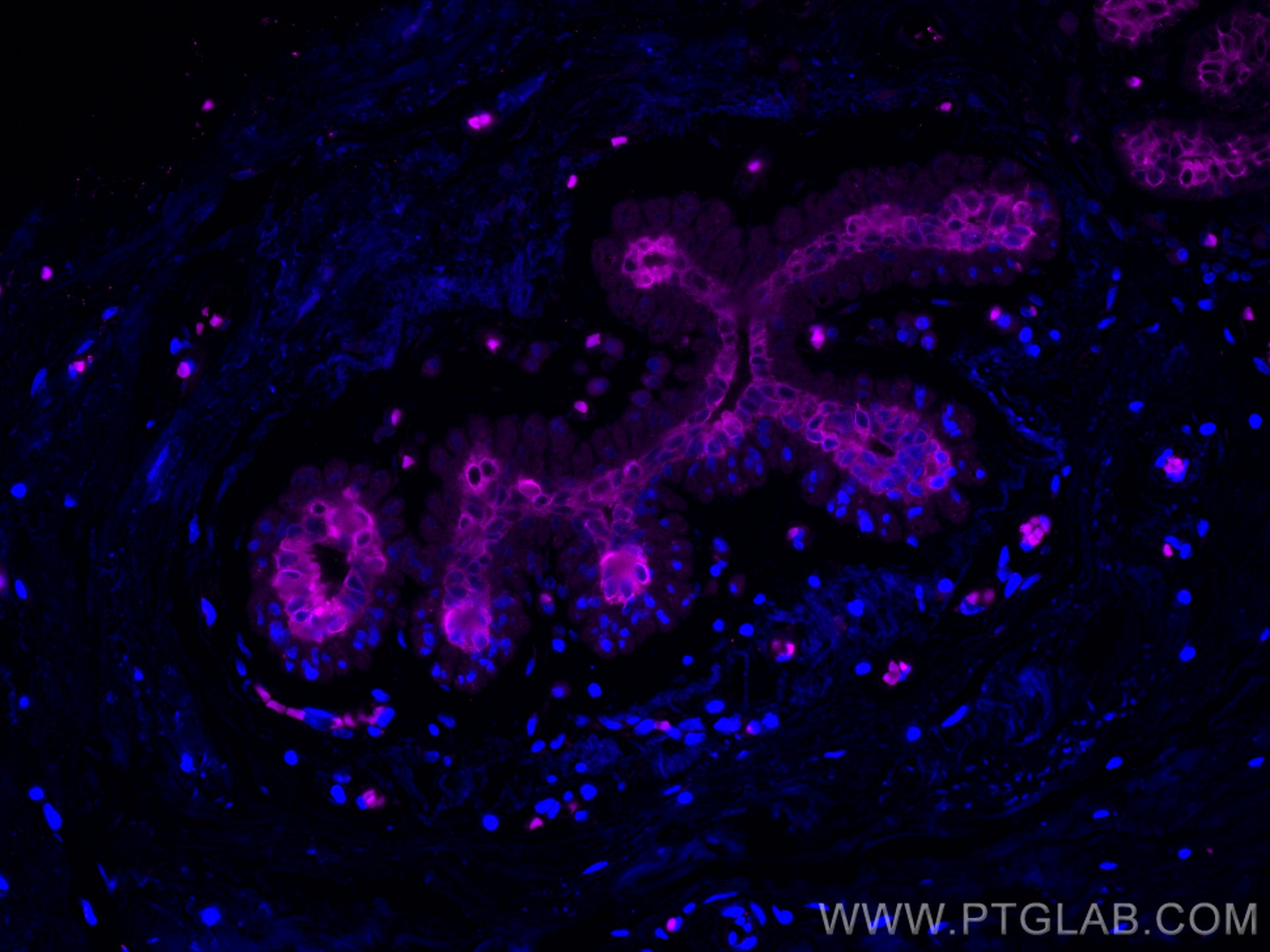 Immunofluorescence (IF) / fluorescent staining of human breast cancer tissue using CoraLite® Plus 647-conjugated Cytokeratin 19 Monoc (CL647-60187)