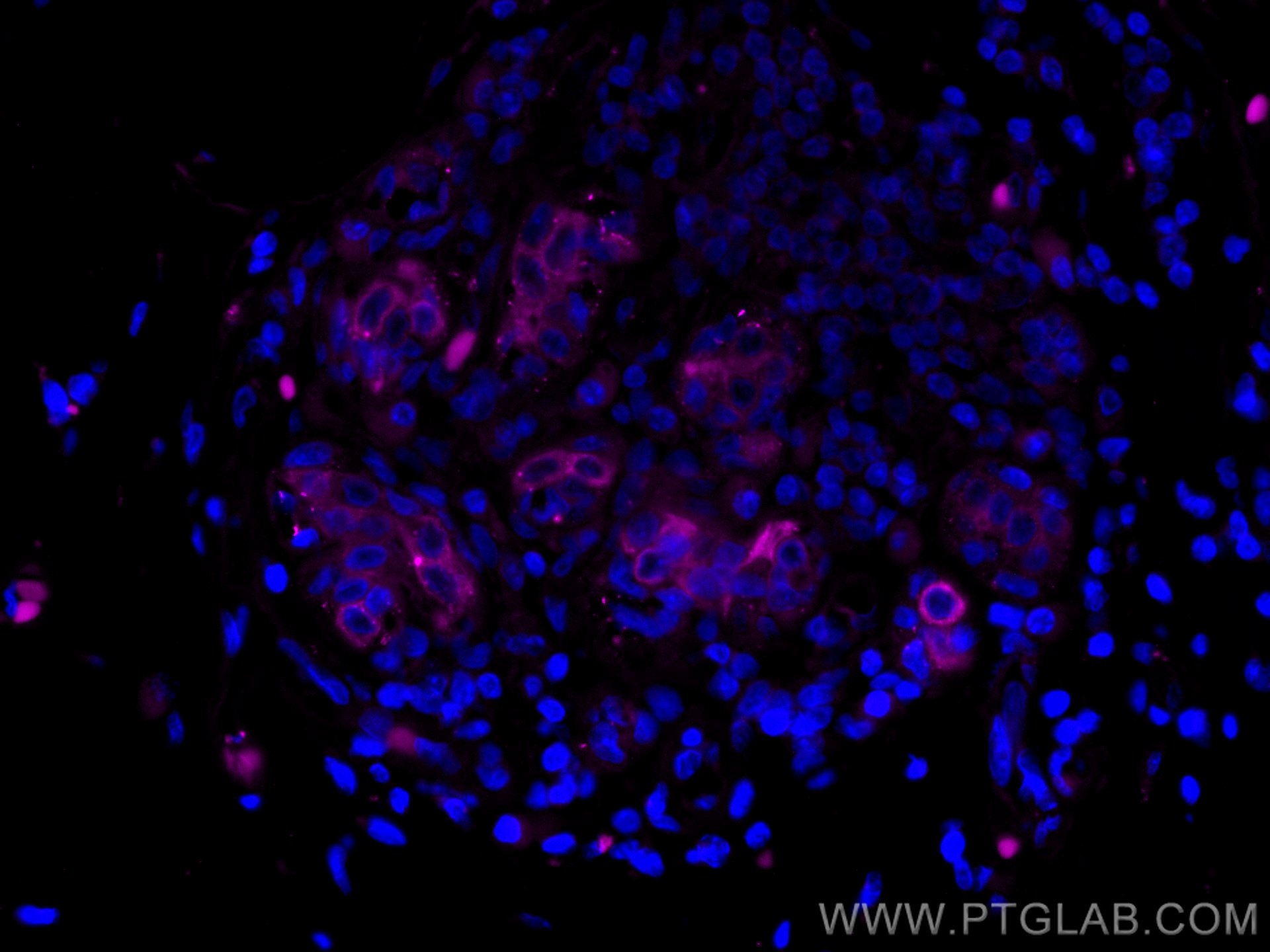 Immunofluorescence (IF) / fluorescent staining of human breast cancer tissue using CoraLite® Plus 647-conjugated Cytokeratin 19 Monoc (CL647-60187)