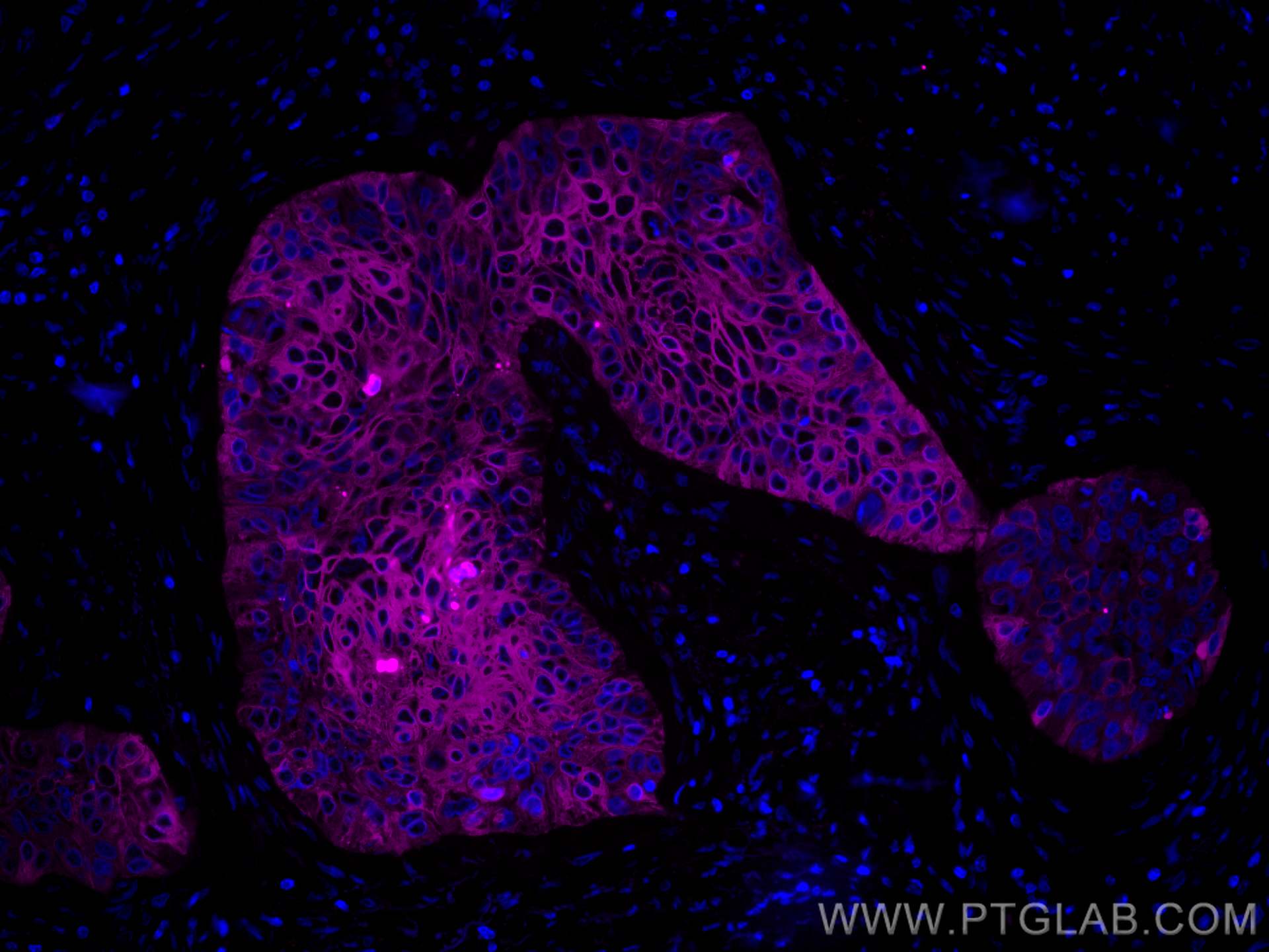 Immunofluorescence (IF) / fluorescent staining of human oesophagus cancer tissue using CoraLite® Plus 647-conjugated Cytokeratin 19 Monoc (CL647-60187)