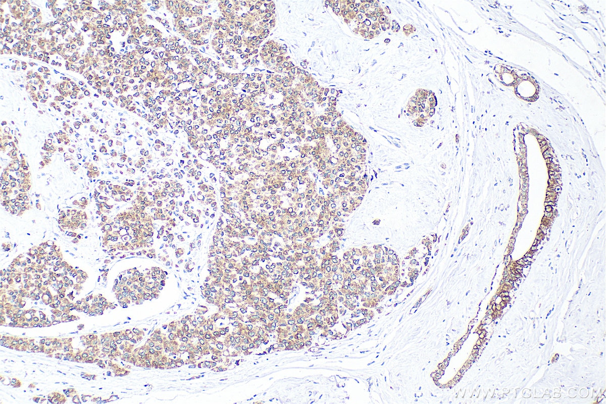 Immunohistochemistry (IHC) staining of human breast cancer tissue using Cytokeratin 24 Polyclonal antibody (33702-1-AP)