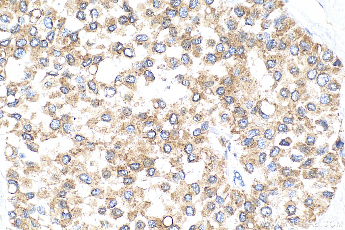 Immunohistochemistry (IHC) staining of human breast cancer tissue using Cytokeratin 24 Polyclonal antibody (33702-1-AP)