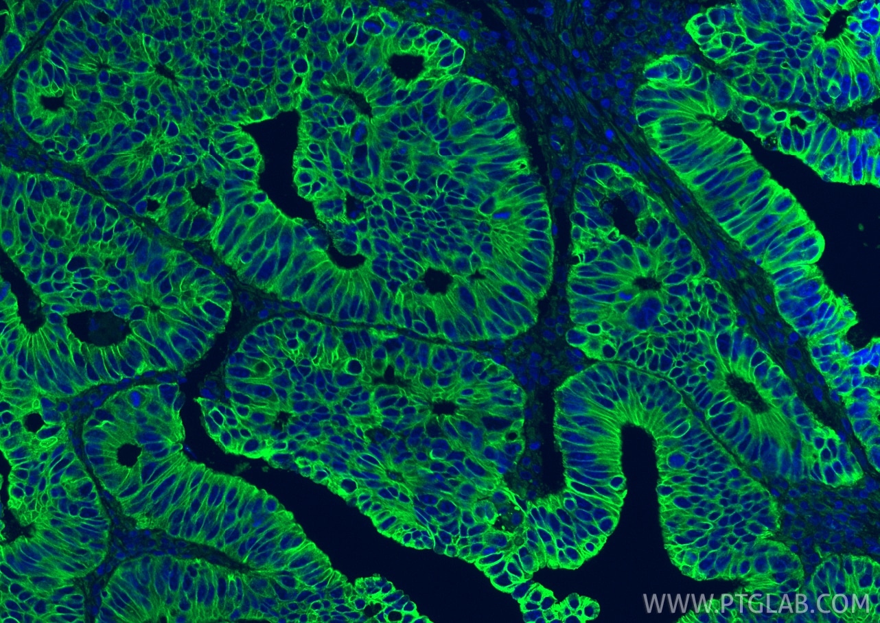 Immunofluorescence (IF) / fluorescent staining of human colon cancer tissue using Cytokeratin 28 Recombinant monoclonal antibody (86434-1-RR)