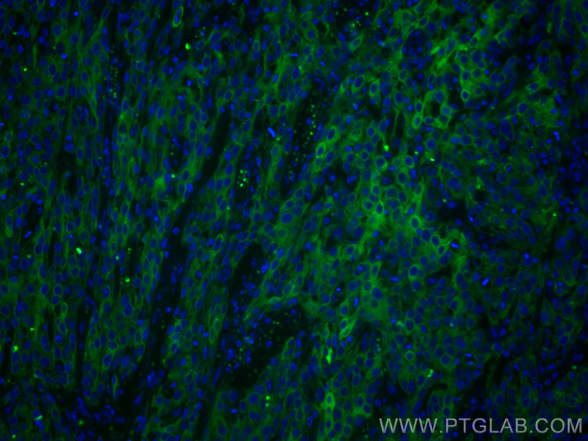 Immunofluorescence (IF) / fluorescent staining of human cervical cancer tissue using Cytokeratin 5/6 Monoclonal antibody (68295-1-Ig)