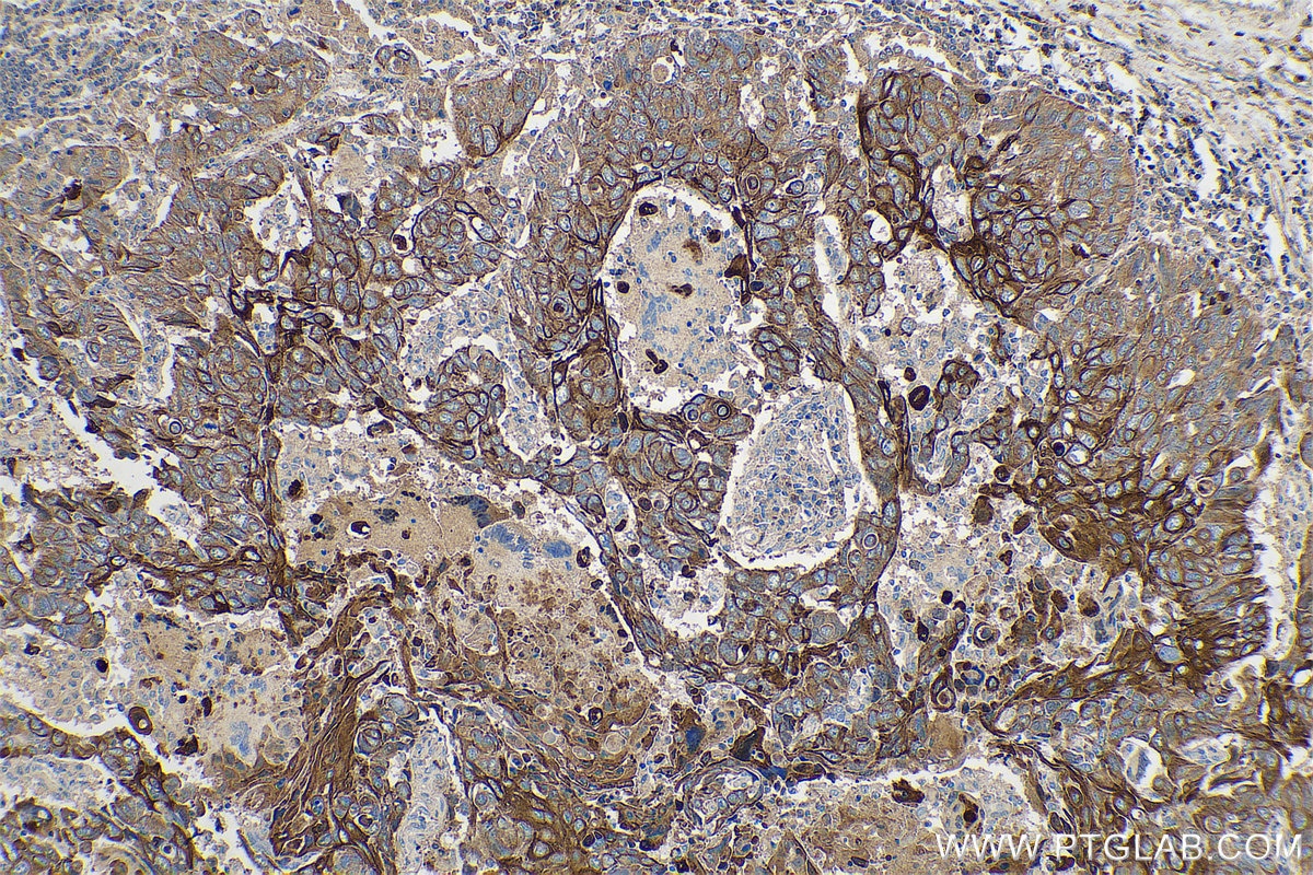 Immunohistochemistry (IHC) staining of human lung cancer tissue using Cytokeratin 5/6 Monoclonal antibody (68295-1-Ig)