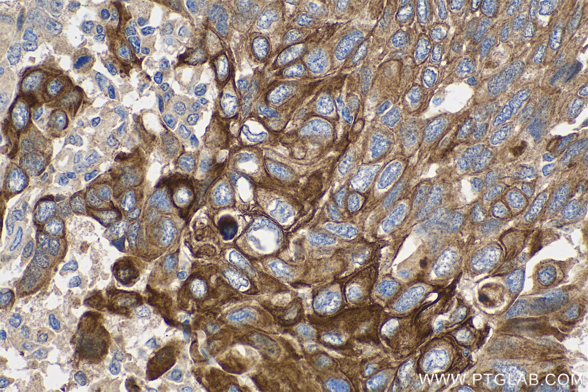 Immunohistochemistry (IHC) staining of human lung cancer tissue using Cytokeratin 5/6 Monoclonal antibody (68295-1-Ig)