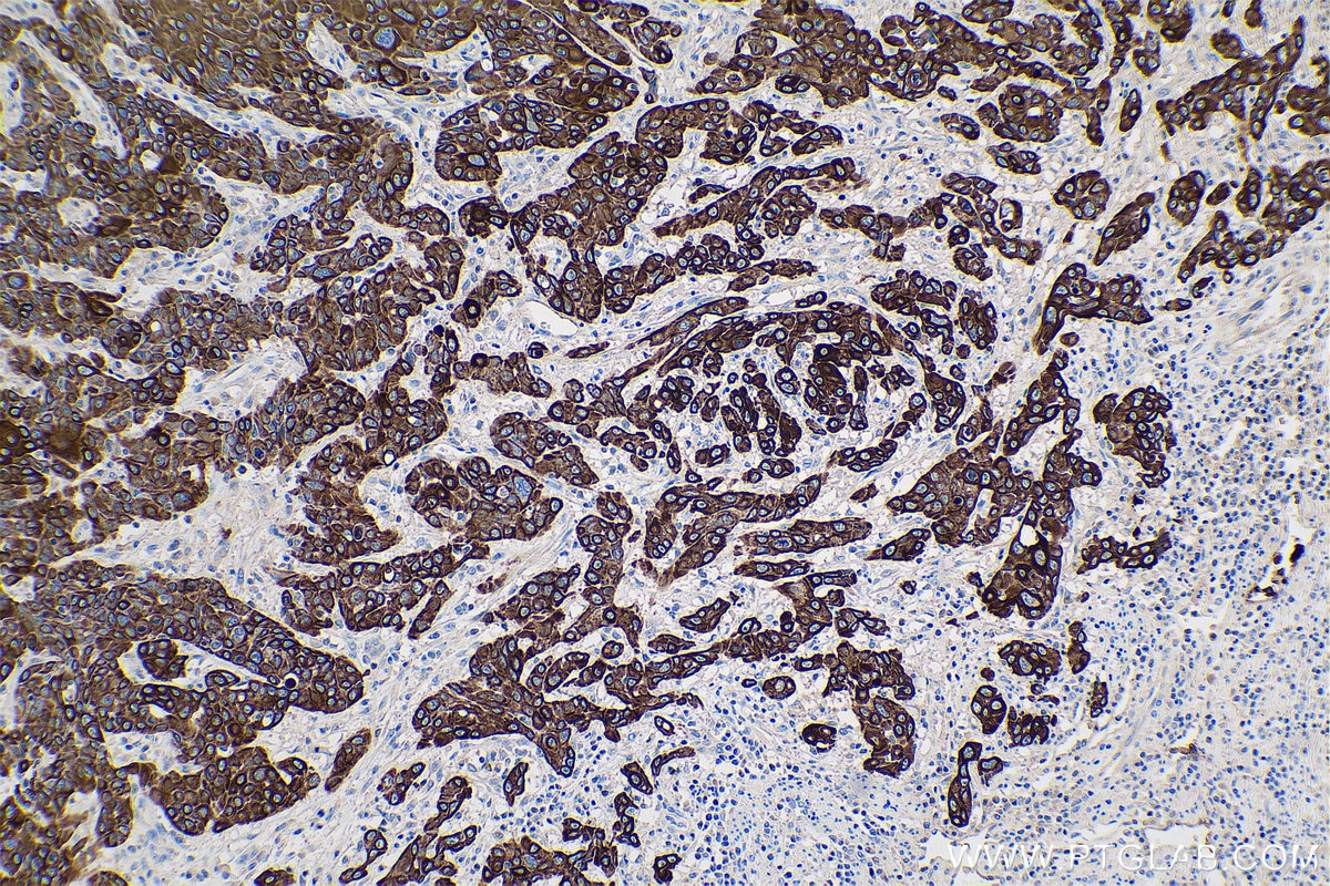 Immunohistochemistry (IHC) staining of human oesophagus cancer tissue using Cytokeratin 5/6 Monoclonal antibody (68295-1-Ig)