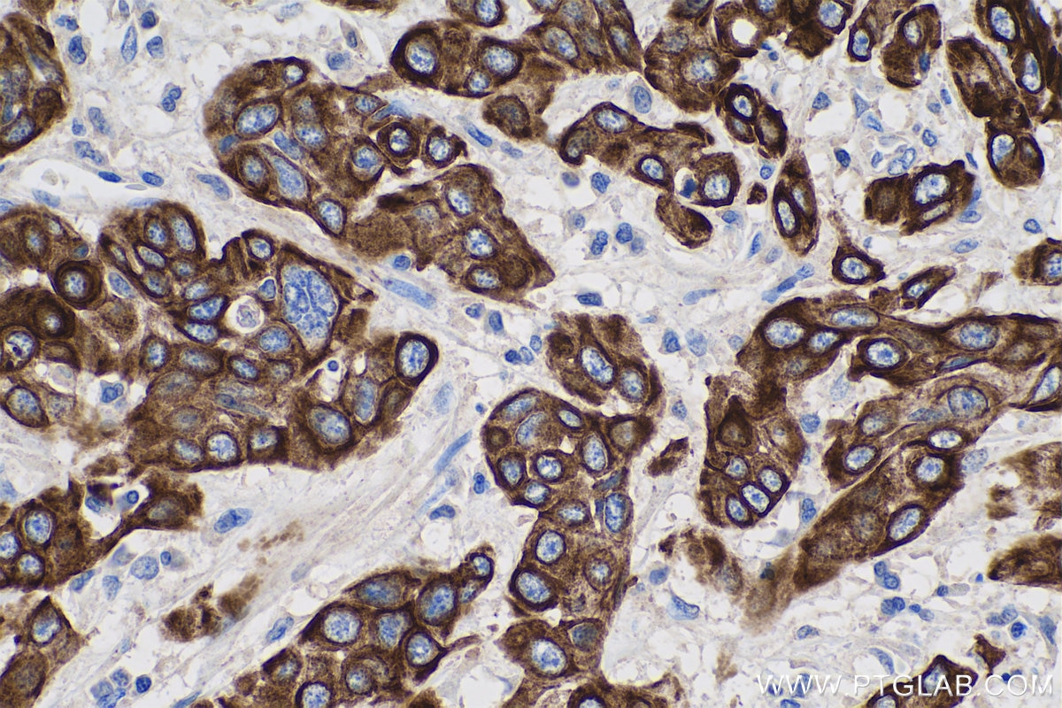 Immunohistochemistry (IHC) staining of human oesophagus cancer tissue using Cytokeratin 5/6 Monoclonal antibody (68295-1-Ig)