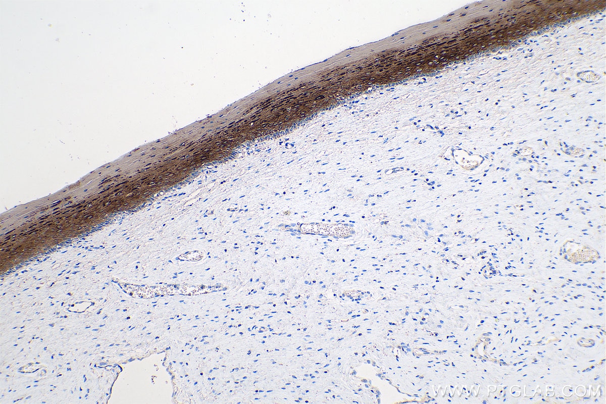 Immunohistochemistry (IHC) staining of human cervical cancer tissue using Cytokeratin 5/6 Monoclonal antibody (68295-1-Ig)