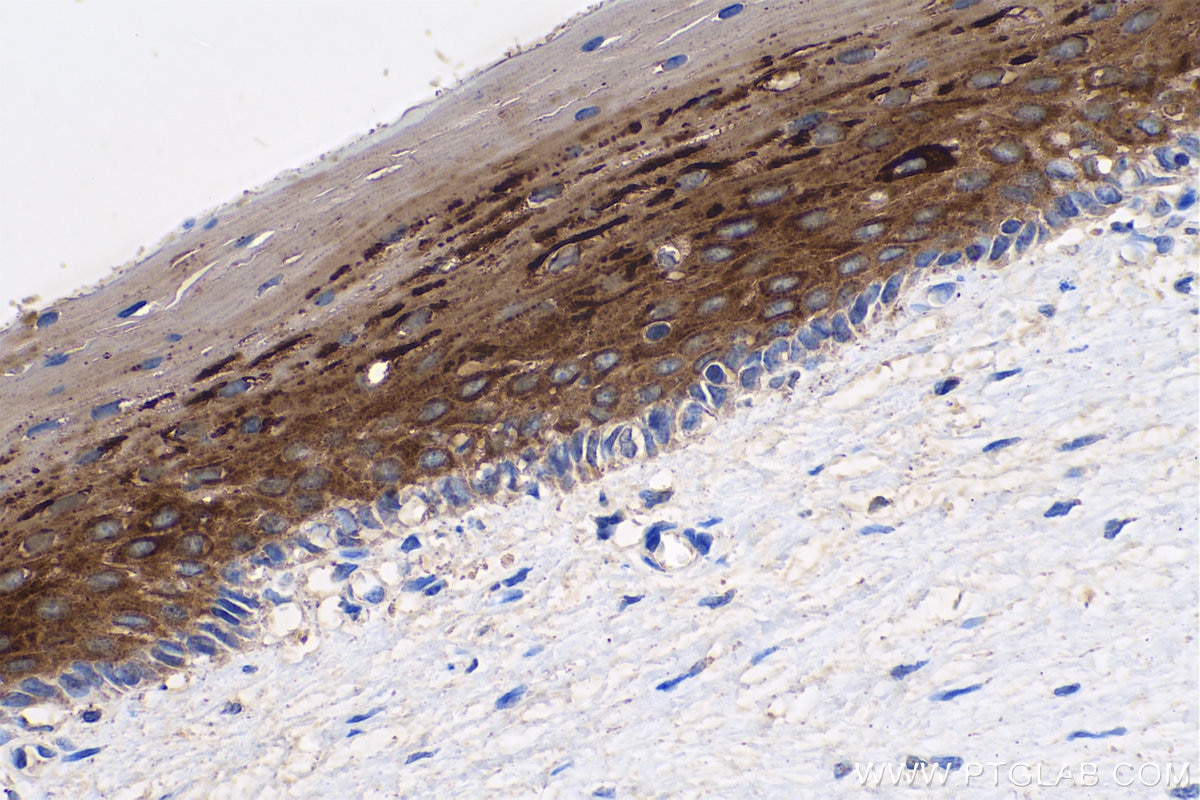 Immunohistochemistry (IHC) staining of human cervical cancer tissue using Cytokeratin 5/6 Monoclonal antibody (68295-1-Ig)