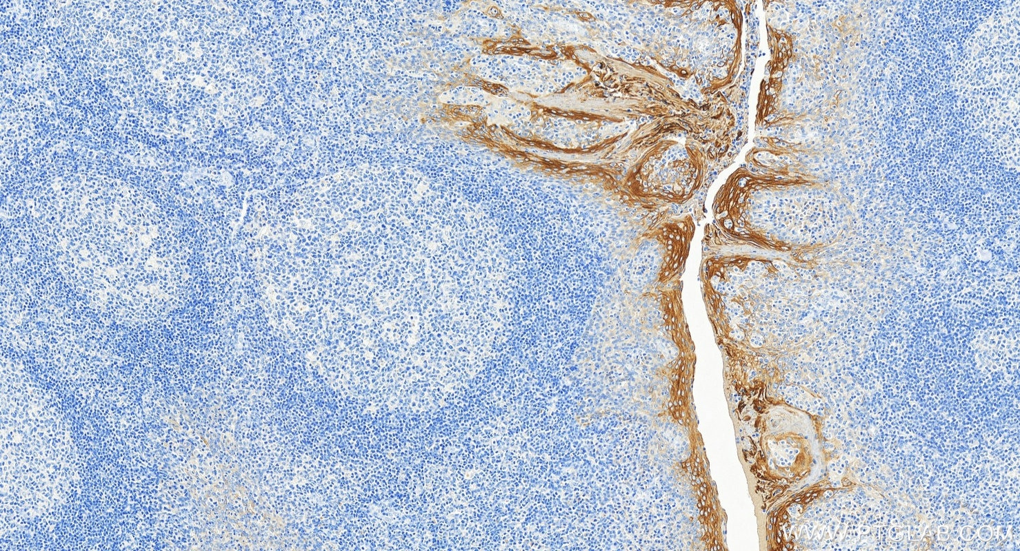 Immunohistochemistry (IHC) staining of human tonsillitis tissue using Cytokeratin 5/6 Monoclonal antibody (68295-1-Ig)