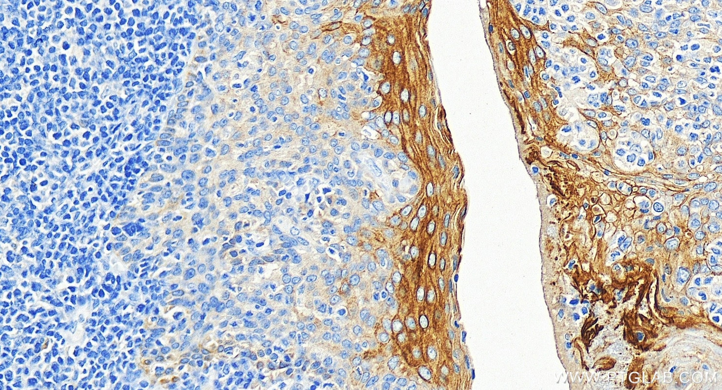 Immunohistochemistry (IHC) staining of human tonsillitis tissue using Cytokeratin 5/6 Monoclonal antibody (68295-1-Ig)