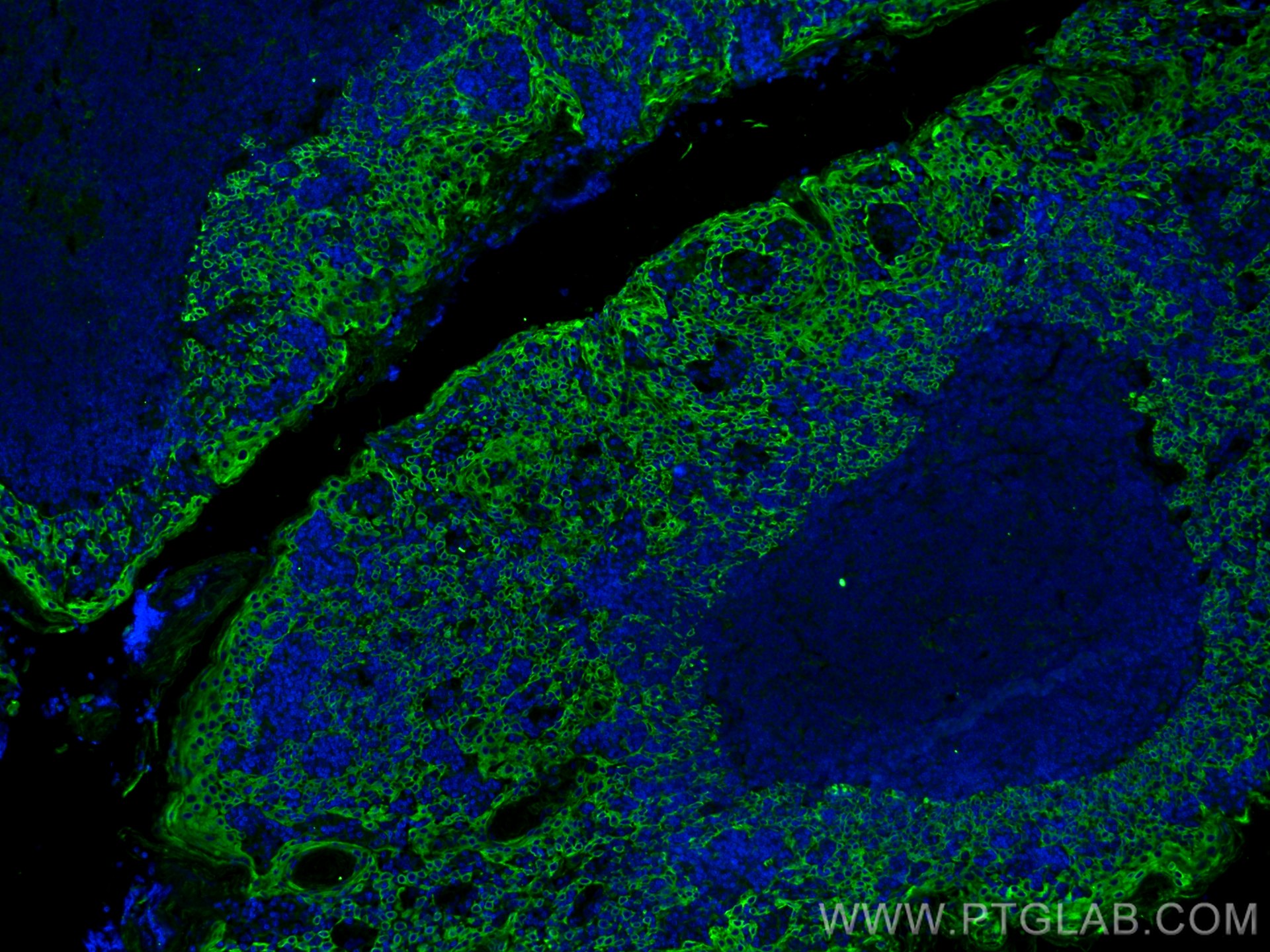 Immunofluorescence (IF) / fluorescent staining of human tonsillitis tissue using Cytokeratin 5 Polyclonal antibody (28506-1-AP)