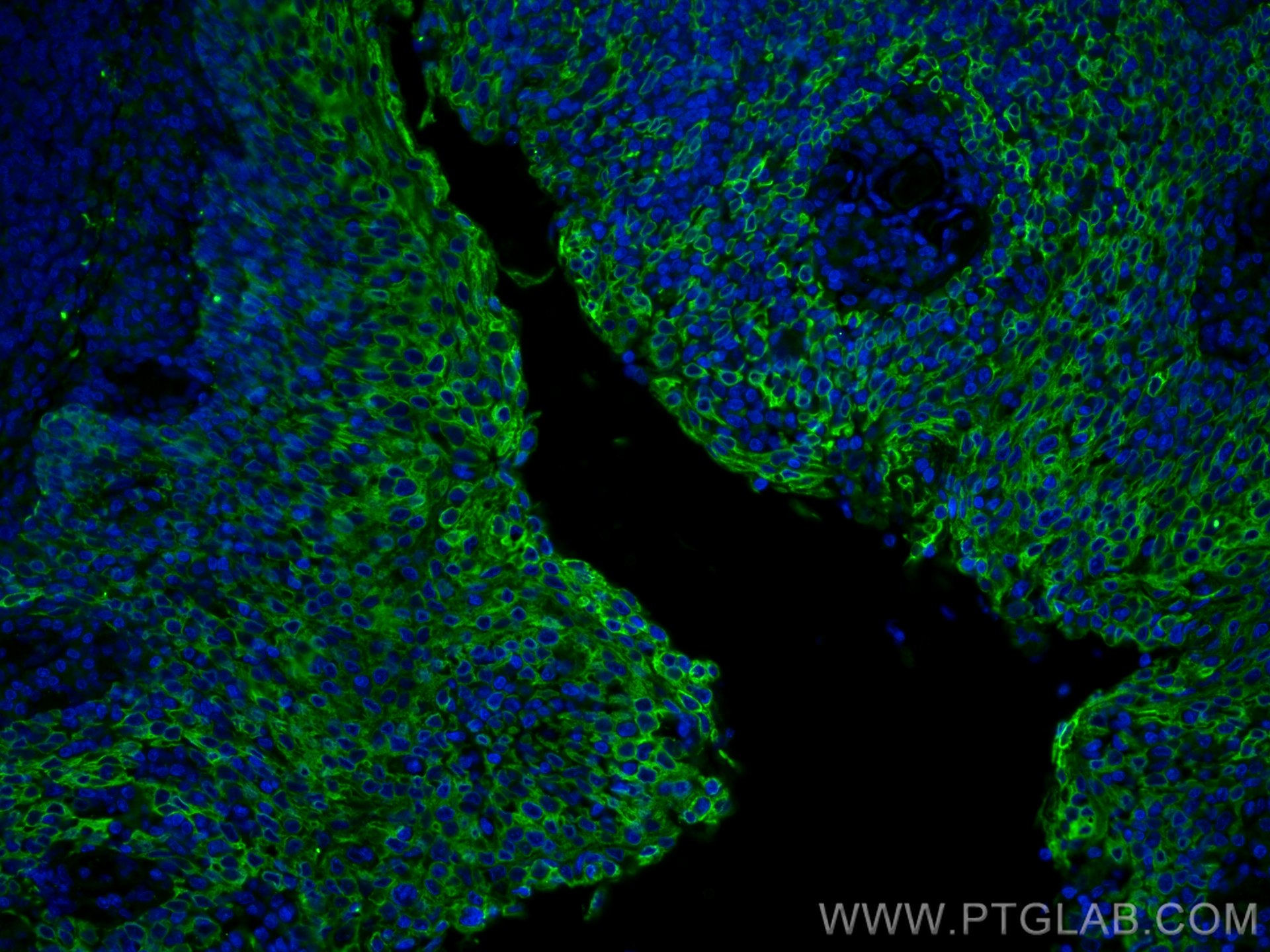 IF Staining of human tonsillitis using 28506-1-AP