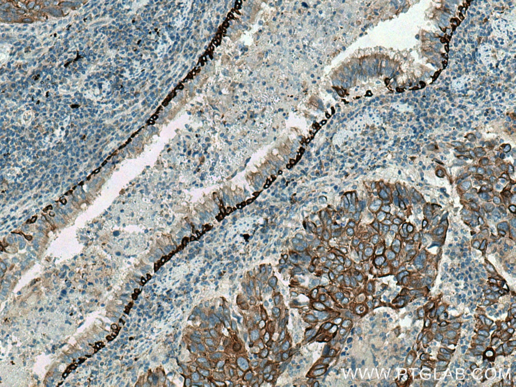 IHC staining of human lung cancer using 28506-1-AP
