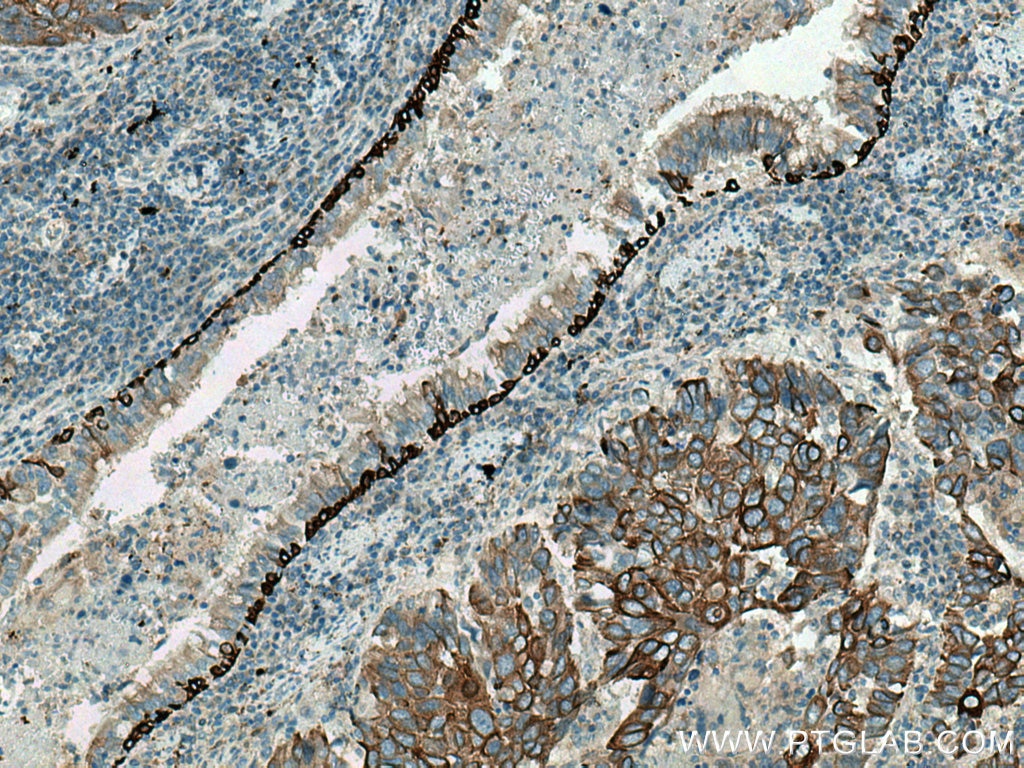 Immunohistochemistry (IHC) staining of human lung cancer tissue using Cytokeratin 5 Polyclonal antibody (28506-1-AP)