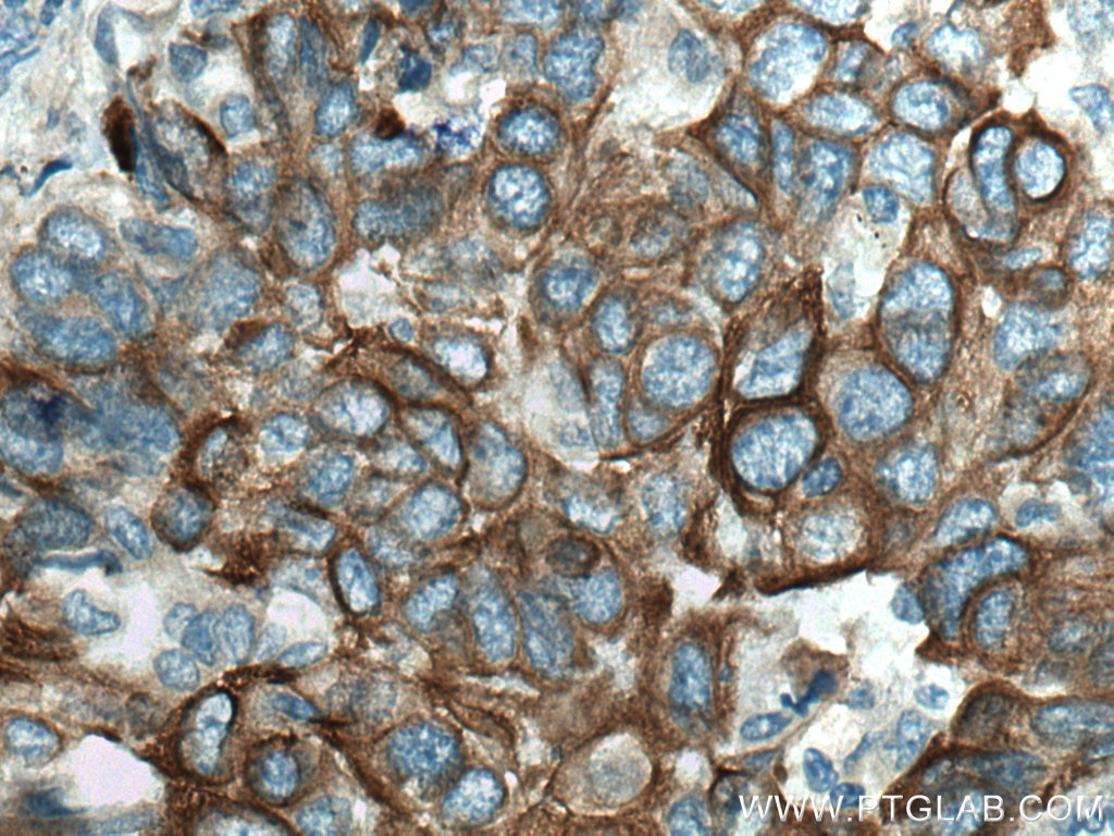 Immunohistochemistry (IHC) staining of human lung cancer tissue using Cytokeratin 5 Polyclonal antibody (28506-1-AP)