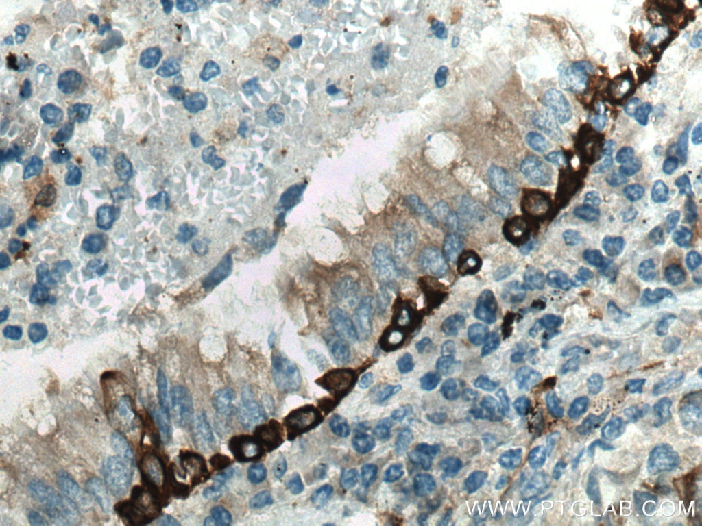 Immunohistochemistry (IHC) staining of human lung cancer tissue using Cytokeratin 5 Polyclonal antibody (28506-1-AP)