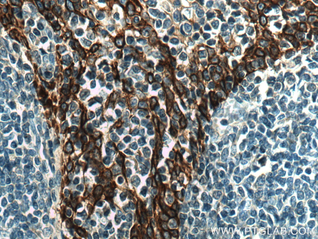 Immunohistochemistry (IHC) staining of human tonsillitis tissue using Cytokeratin 5 Polyclonal antibody (28506-1-AP)