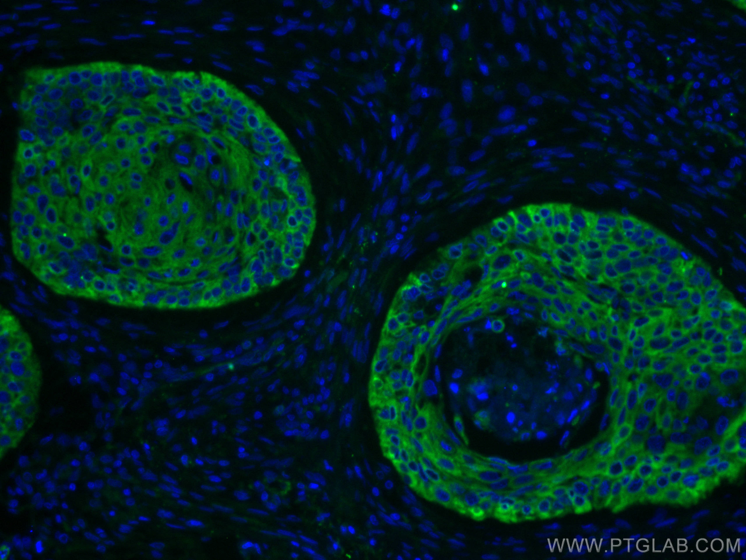 IF Staining of human oesophagus cancer using 66727-1-Ig