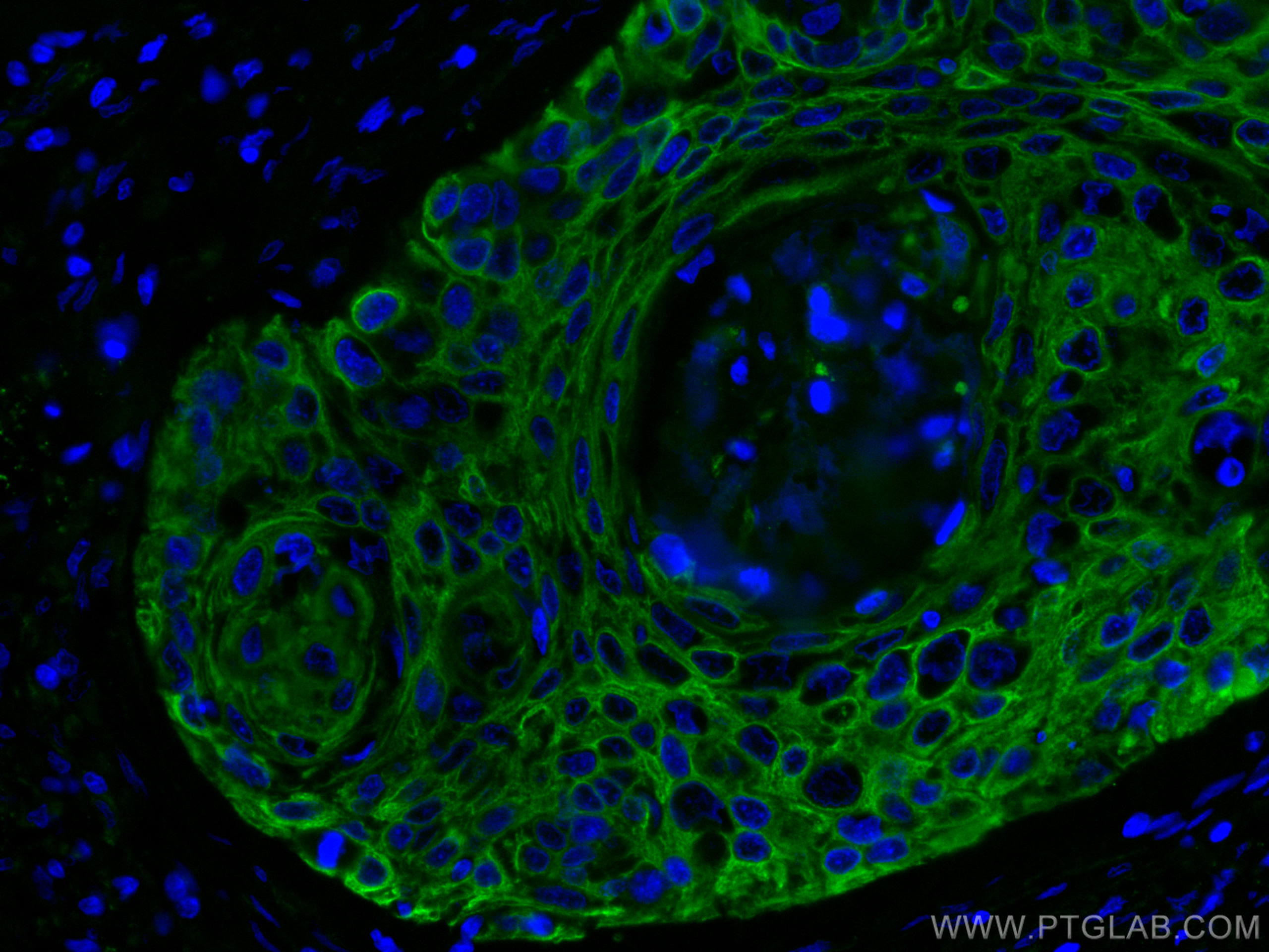 Immunofluorescence (IF) / fluorescent staining of human oesophagus cancer tissue using Cytokeratin 5 Monoclonal antibody (66727-1-Ig)