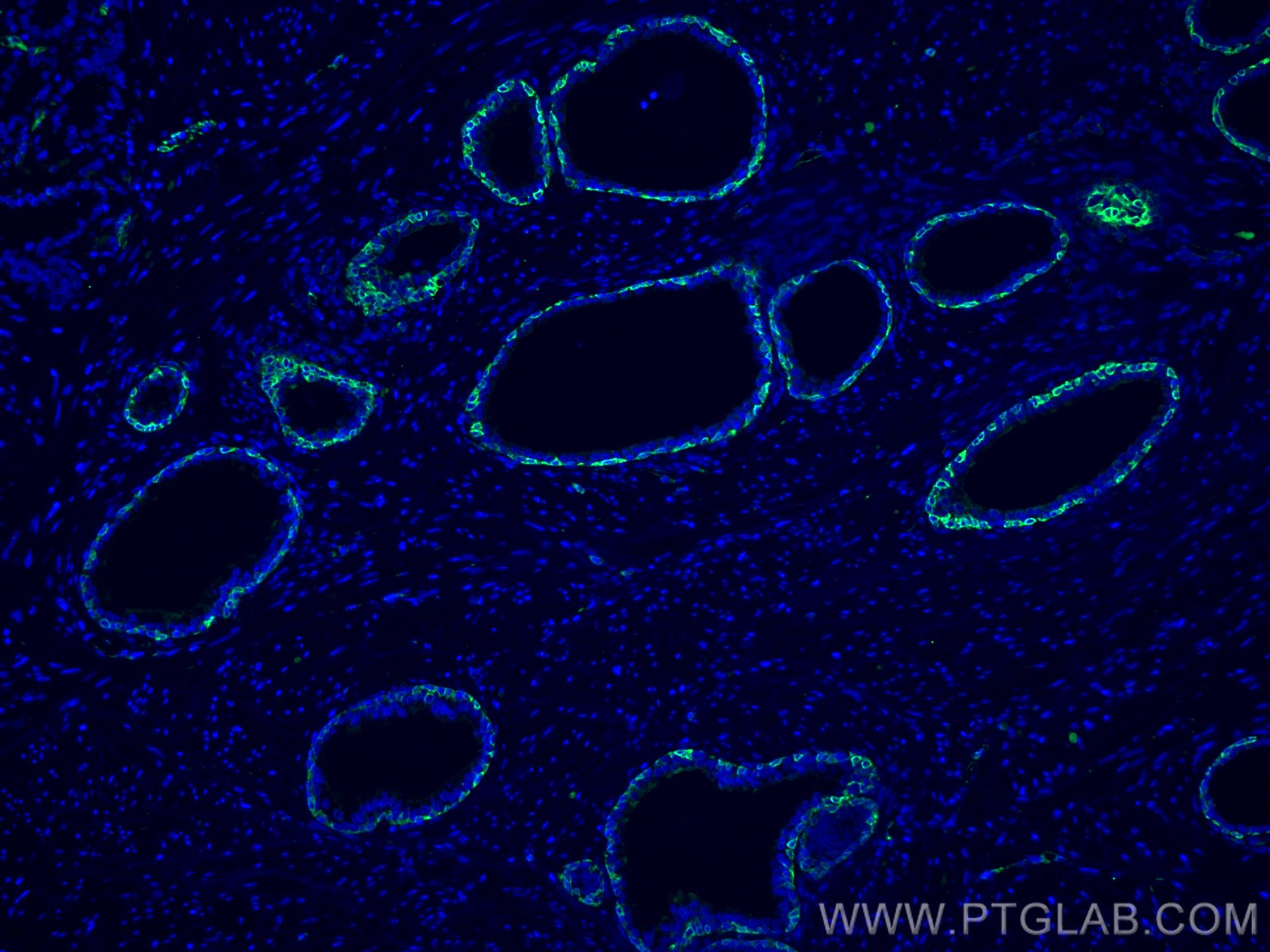 Immunofluorescence (IF) / fluorescent staining of human prostate cancer tissue using Cytokeratin 5 Monoclonal antibody (66727-1-Ig)