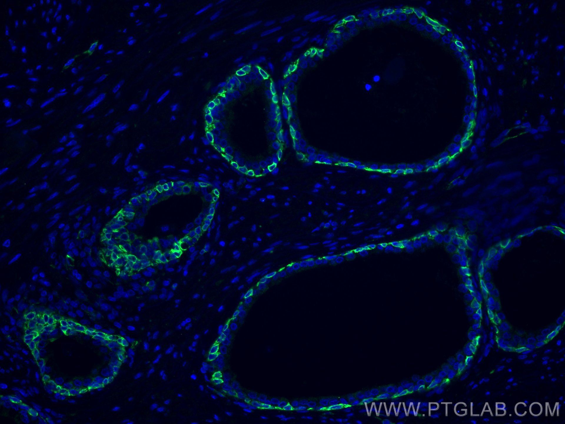 Immunofluorescence (IF) / fluorescent staining of human prostate cancer tissue using Cytokeratin 5 Monoclonal antibody (66727-1-Ig)