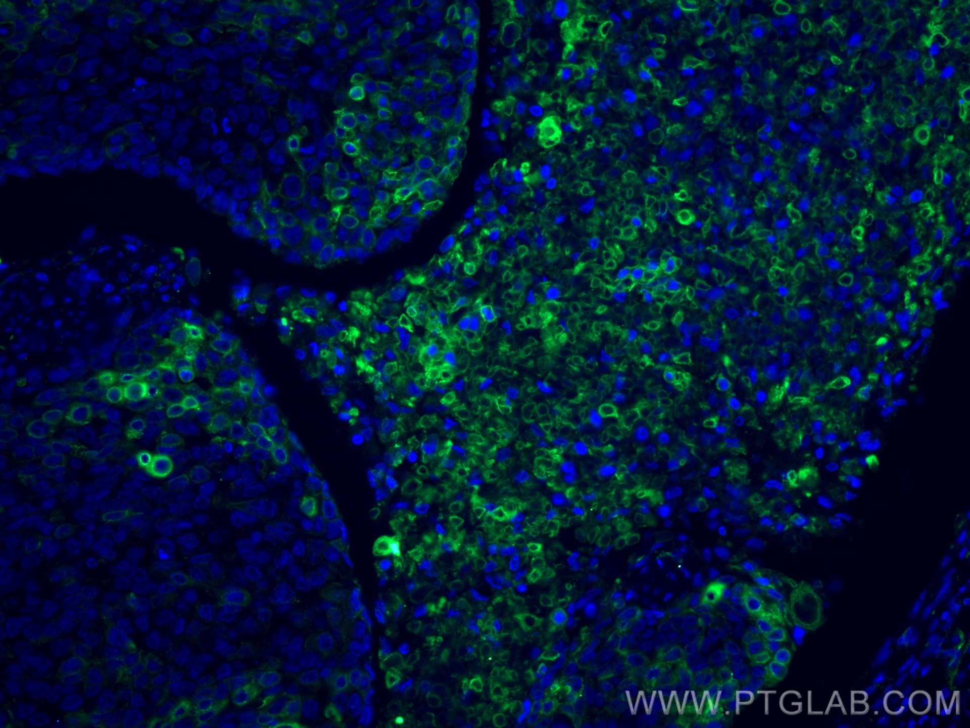 Immunofluorescence (IF) / fluorescent staining of human oesophagus cancer tissue using Cytokeratin 5 Monoclonal antibody (66727-1-Ig)