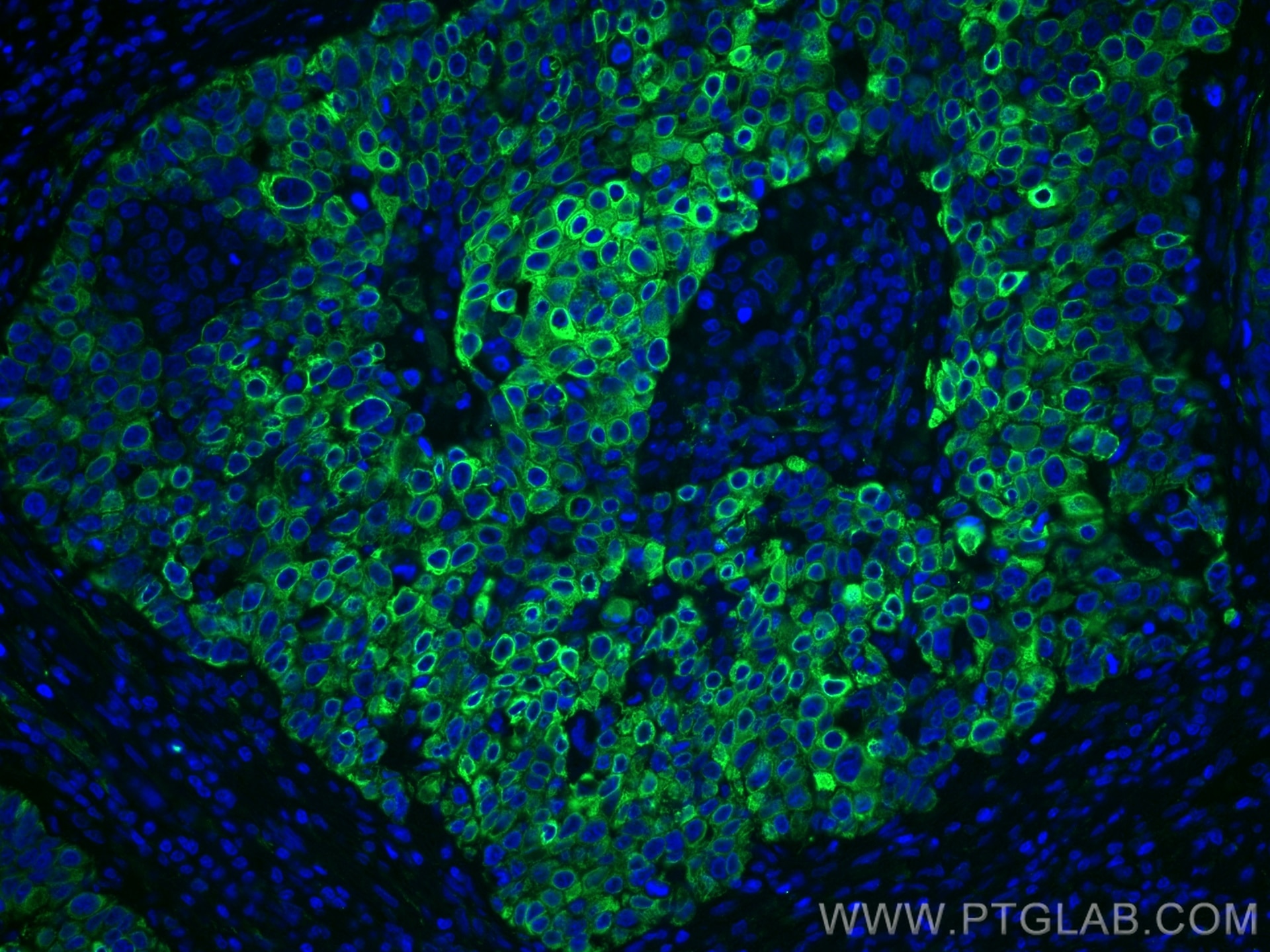 Immunofluorescence (IF) / fluorescent staining of human oesophagus cancer tissue using Cytokeratin 5 Monoclonal antibody (66727-1-Ig)