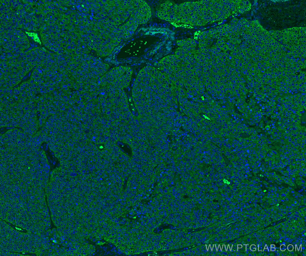 Immunofluorescence (IF) / fluorescent staining of human lung cancer tissue using Cytokeratin 5 Monoclonal antibody (66727-1-Ig)