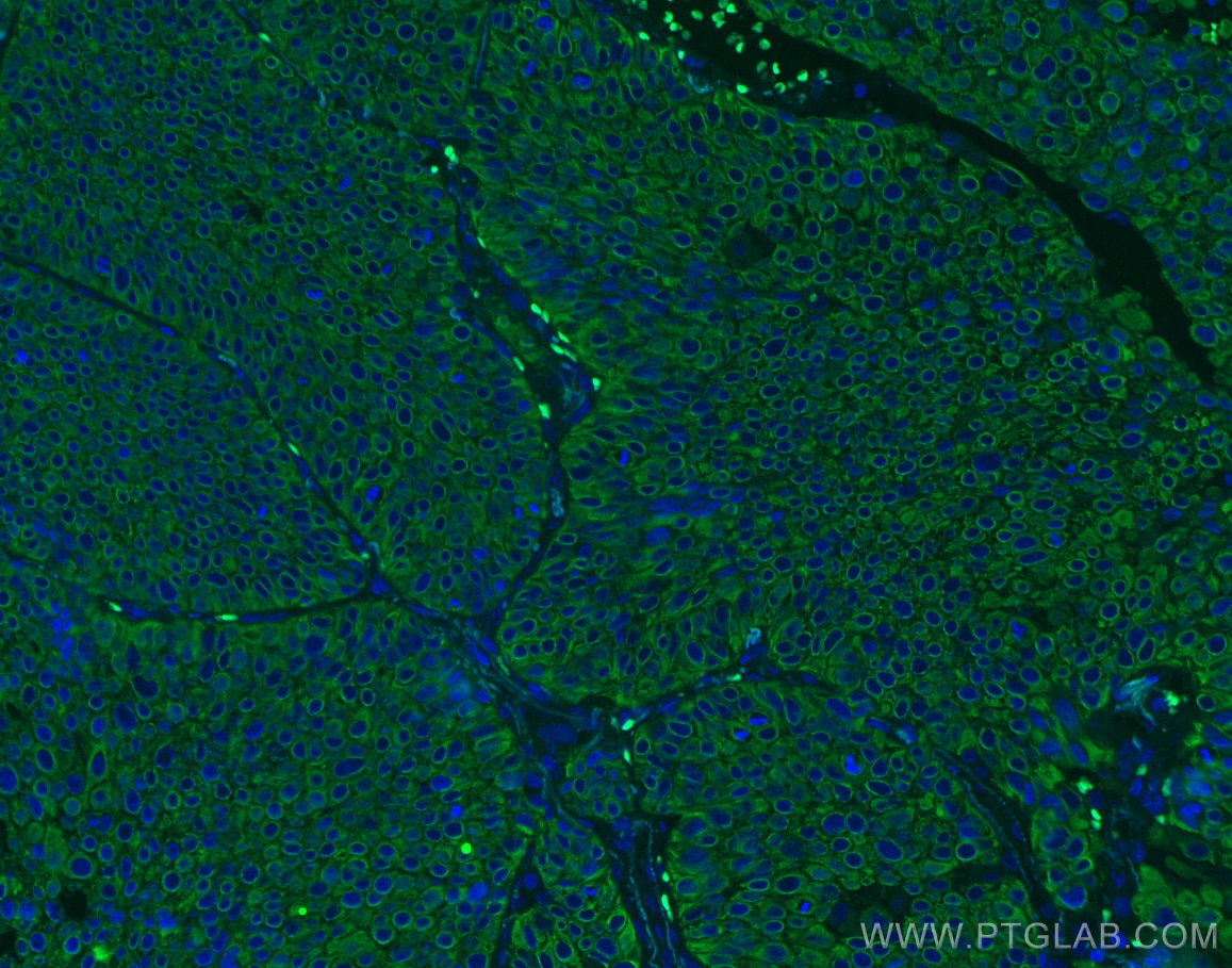 Immunofluorescence (IF) / fluorescent staining of human lung cancer tissue using Cytokeratin 5 Monoclonal antibody (66727-1-Ig)