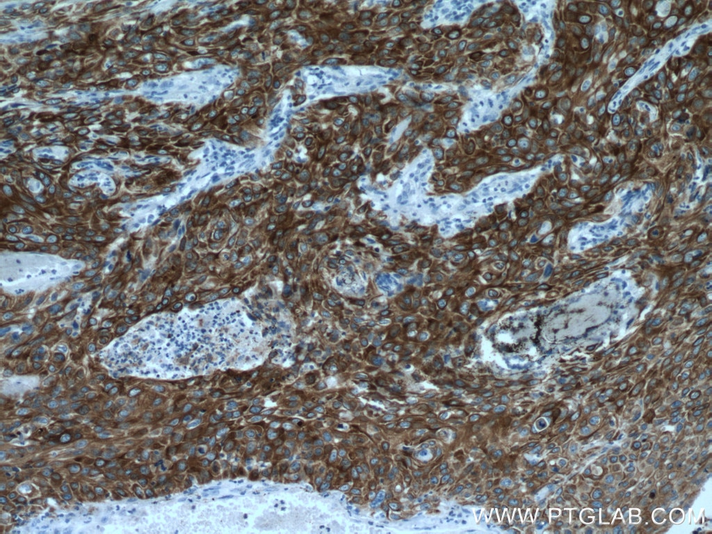 IHC staining of human cervical cancer using 66727-1-Ig