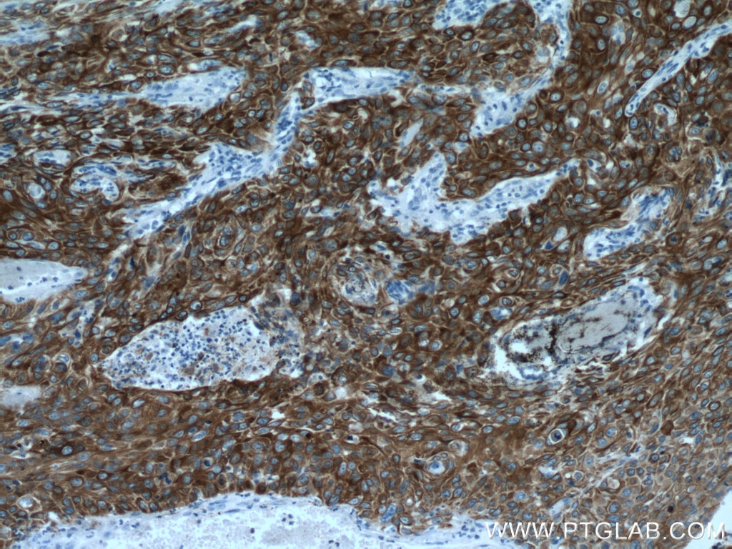 Immunohistochemistry (IHC) staining of human cervical cancer tissue using Cytokeratin 5 Monoclonal antibody (66727-1-Ig)