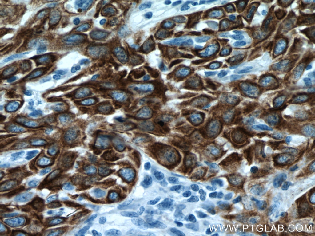 Immunohistochemistry (IHC) staining of human cervical cancer tissue using Cytokeratin 5 Monoclonal antibody (66727-1-Ig)
