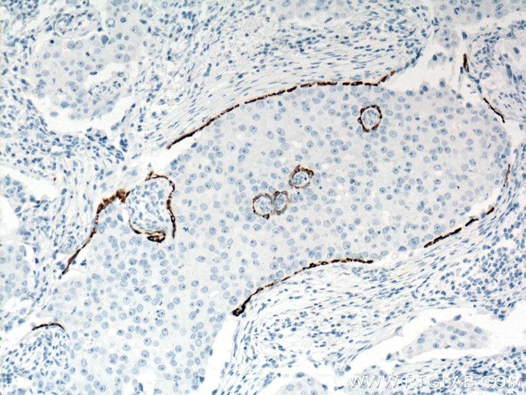 Immunohistochemistry (IHC) staining of human breast cancer tissue using Cytokeratin 5 Monoclonal antibody (66727-1-Ig)