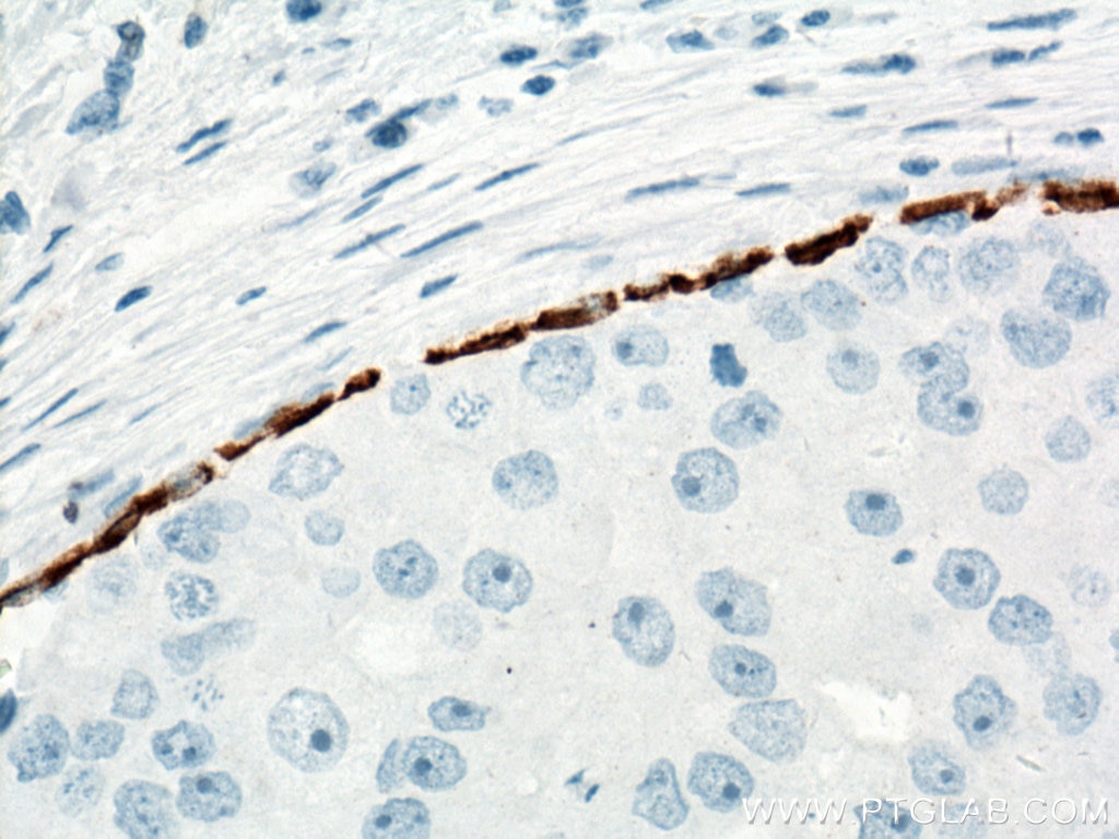 Immunohistochemistry (IHC) staining of human breast cancer tissue using Cytokeratin 5 Monoclonal antibody (66727-1-Ig)