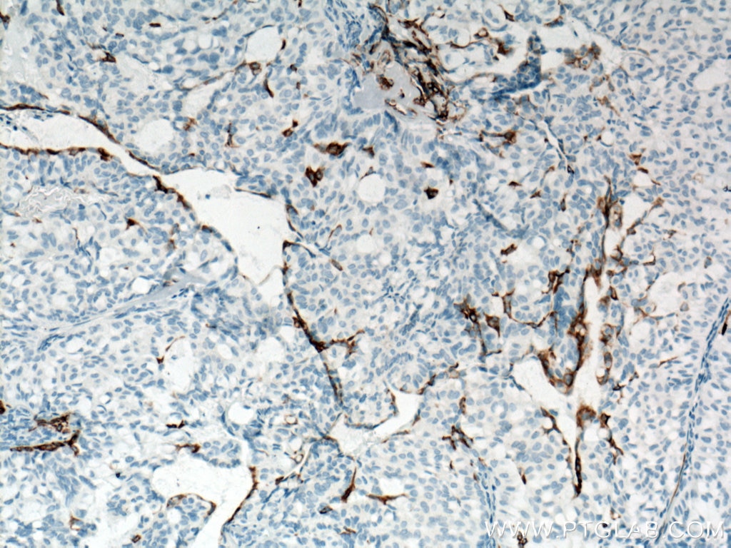 Immunohistochemistry (IHC) staining of human breast hyperplasia tissue using Cytokeratin 5 Monoclonal antibody (66727-1-Ig)