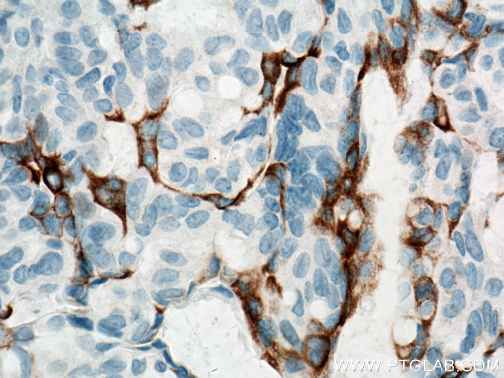 Immunohistochemistry (IHC) staining of human breast hyperplasia tissue using Cytokeratin 5 Monoclonal antibody (66727-1-Ig)