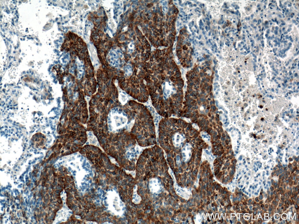 Immunohistochemistry (IHC) staining of human lung cancer tissue using Cytokeratin 5 Monoclonal antibody (66727-1-Ig)