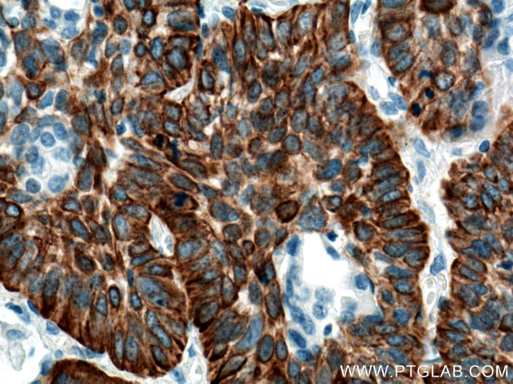 Immunohistochemistry (IHC) staining of human lung cancer tissue using Cytokeratin 5 Monoclonal antibody (66727-1-Ig)