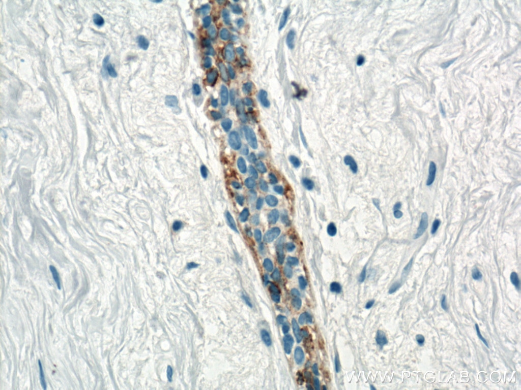 Immunohistochemistry (IHC) staining of human breast hyperplasia tissue using Cytokeratin 5 Monoclonal antibody (66727-1-Ig)