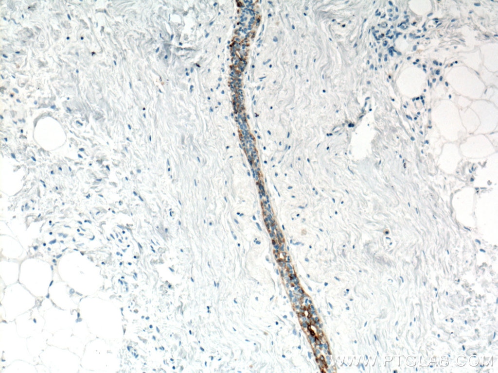 Immunohistochemistry (IHC) staining of human breast hyperplasia tissue using Cytokeratin 5 Monoclonal antibody (66727-1-Ig)